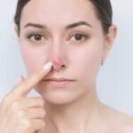 Boutons sur le nez : d'où viennent-ils et comment les faire disparaître